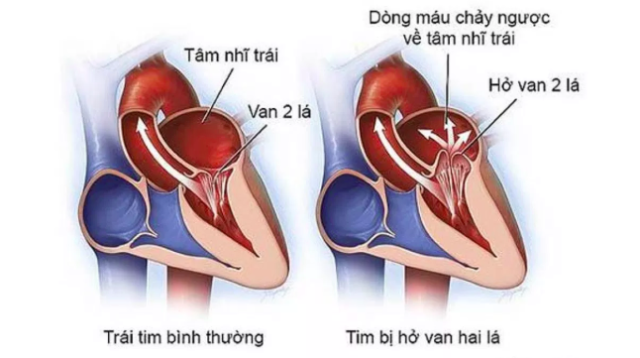 hỏ van tim 