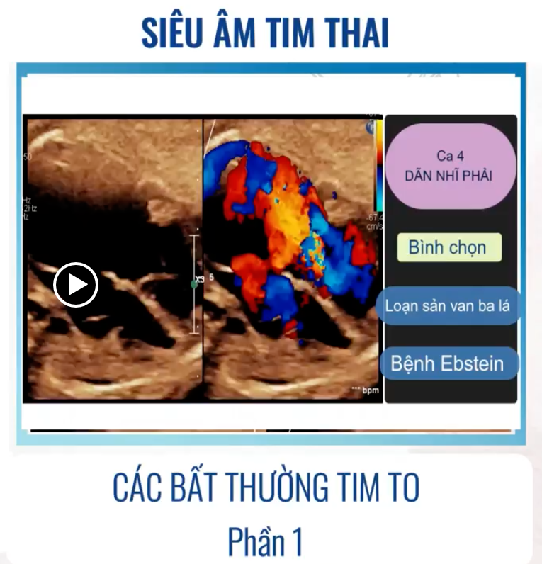 SIÊU ÂM TIM THAI BỆNH LÝ: CÁC BẤT THƯỜNG TIM TO (P1) – Kết quả chẩn đoán