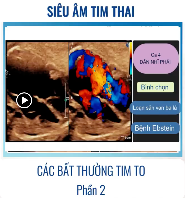 SIÊU ÂM TIM THAI BỆNH LÝ – CÁC BẤT THƯỜNG TIM TO (P2) – Thảo luận