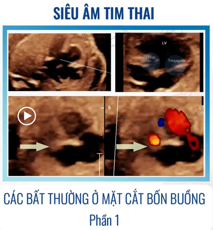 SIÊU ÂM TIM THAI BỆNH LÝ – CÁC BẤT THƯỜNG Ở MẶT CẮT 4 BUỒNG (P1) – Thảo luận