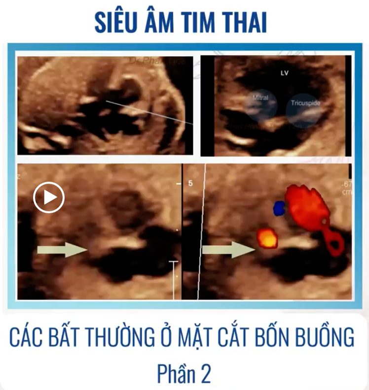 SIÊU ÂM TIM THAI BỆNH LÝ – CÁC BẤT THƯỜNG Ở MẶT CẮT 4 BUỒNG (P2) – Thảo luận
