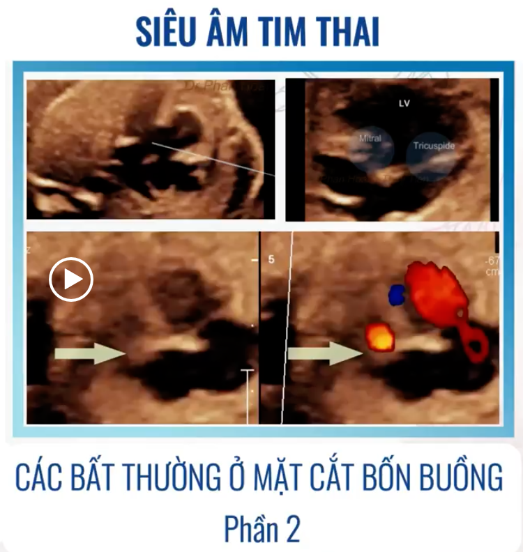 SIÊU ÂM TIM THAI BỆNH LÝ – CÁC BẤT THƯỜNG Ở MẶT CẮT 4 BUỒNG (P2) – Chẩn đoán