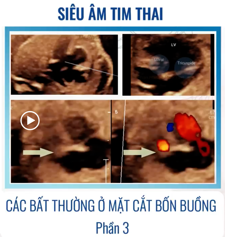SIÊU ÂM TIM THAI BỆNH LÝ – CÁC BẤT THƯỜNG Ở MẶT CẮT 4 BUỒNG (P3) – Thảo luận