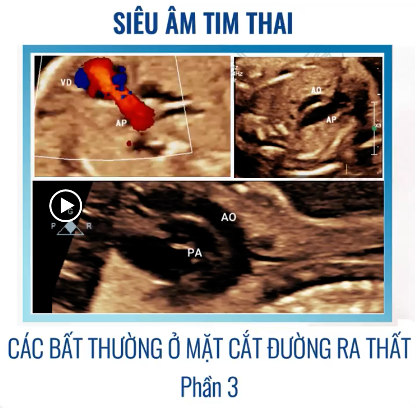 SIÊU ÂM TIM THAI BỆNH LÝ – CÁC BẤT THƯỜNG Ở MẶT CẮT ĐƯỜNG RA THẤT (P3) – Chẩn đoán