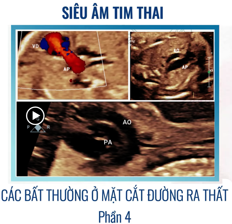 SIÊU ÂM TIM THAI BỆNH LÝ – CÁC BẤT THƯỜNG Ở MẶT CẮT ĐƯỜNG RA THẤT (P4) – Thảo luận