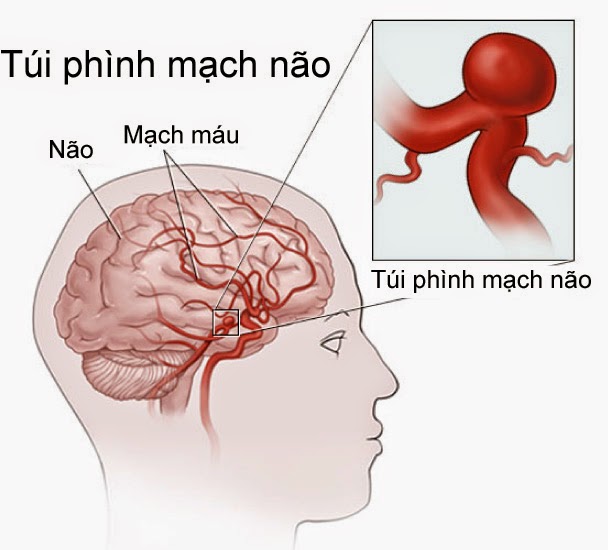 vỡ mạch máu não là gì?