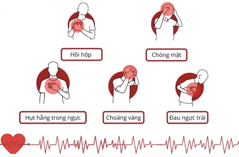 dấu hiệu của ngoại tâm thu