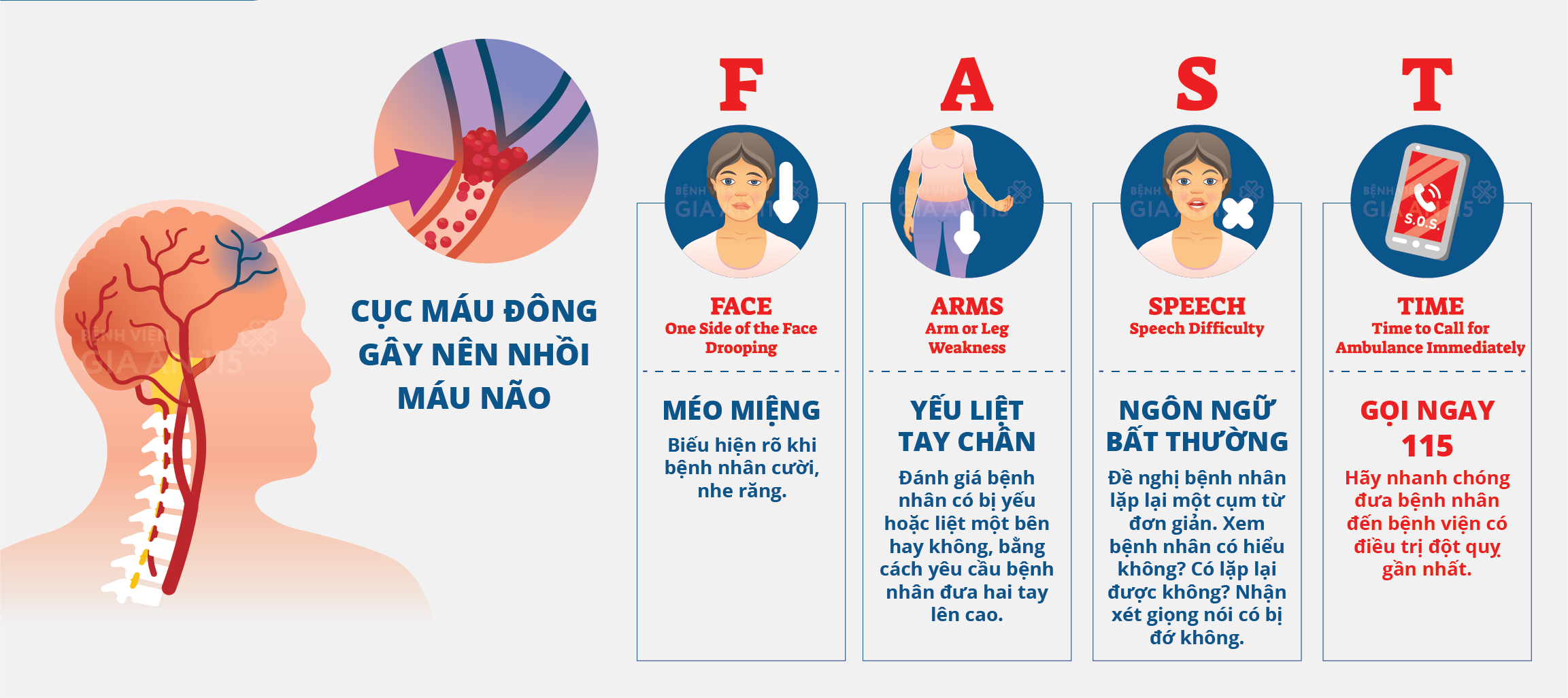 Triệu chứng của nhồi máu não