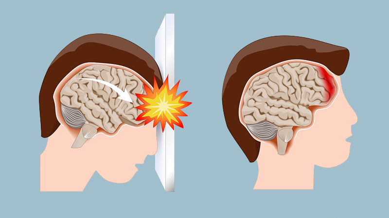 nguyên nhân gây xuất huyết não