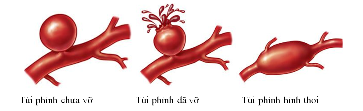 Các dấu hiệu nhận biết phình mạch máu não