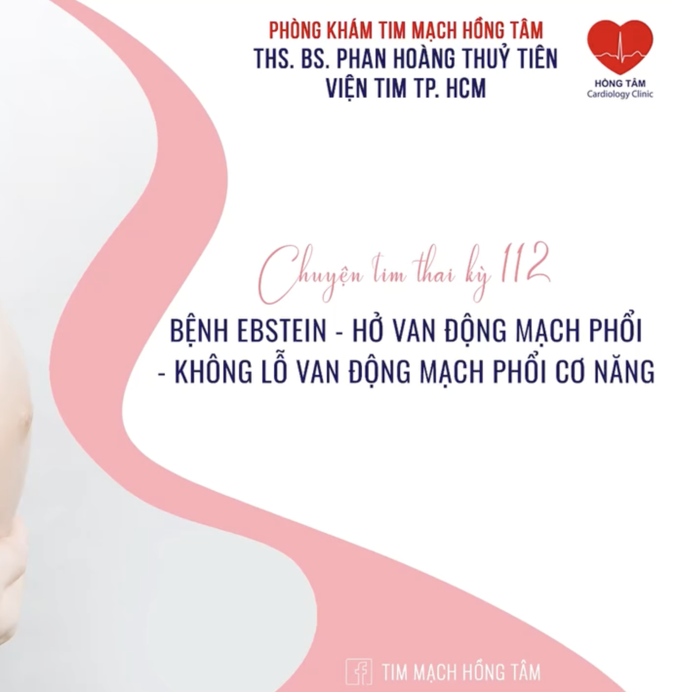 CHUYỆN TIM THAI KỲ 112 – BỆNH EBSTEIN – HỞ VAN ĐỘNG MẠCH PHỔI – KHÔNG LỖ VAN ĐỘNG MẠCH PHỔI CƠ NĂNG